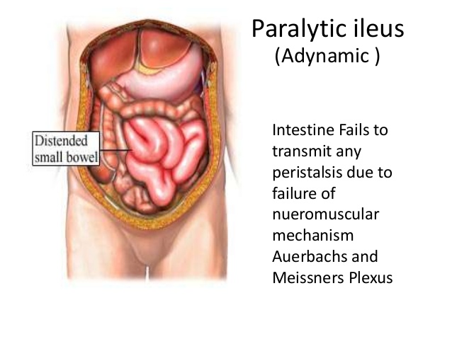 ileus-diagnosa-dan-pengobatan